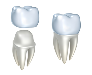 Dental Crowns and Bridges Easton MD