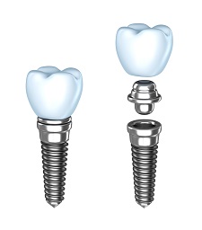 Dental Implants Easton MD